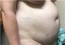Tummy Tuck Before Photo by Ankit Desai, MD; Jacksonville, FL - Case 38968