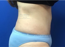 Tummy Tuck After Photo by Ankit Desai, MD; Jacksonville, FL - Case 38968