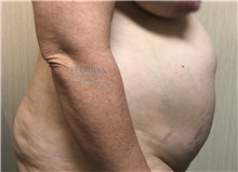 Tummy Tuck Before Photo by Ankit Desai, MD; Jacksonville, FL - Case 38968