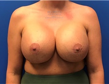 Breast Implant Revision After Photo by Ankit Desai, MD; Jacksonville, FL - Case 39172