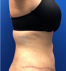 Tummy Tuck After Photo by Ankit Desai, MD; Jacksonville, FL - Case 40341