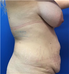 Tummy Tuck Before Photo by Ankit Desai, MD; Jacksonville, FL - Case 40341