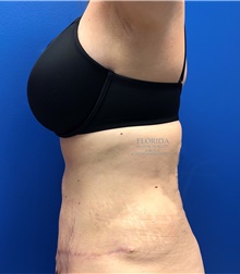Tummy Tuck After Photo by Ankit Desai, MD; Jacksonville, FL - Case 40341