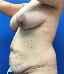 Tummy Tuck Before Photo by Ankit Desai, MD; Jacksonville, FL - Case 40341