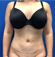 Tummy Tuck After Photo by Ankit Desai, MD; Jacksonville, FL - Case 40341
