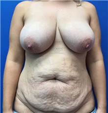 Tummy Tuck Before Photo by Ankit Desai, MD; Jacksonville, FL - Case 40341