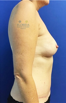 Breast Reconstruction After Photo by Ankit Desai, MD; Jacksonville, FL - Case 40567
