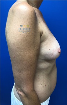 Breast Reconstruction Before Photo by Ankit Desai, MD; Jacksonville, FL - Case 40567
