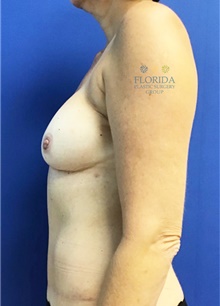 Breast Reconstruction After Photo by Ankit Desai, MD; Jacksonville, FL - Case 40567