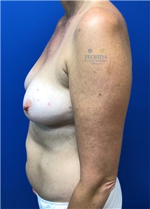 Breast Reconstruction Before Photo by Ankit Desai, MD; Jacksonville, FL - Case 40567