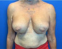 Breast Implant Revision After Photo by Ankit Desai, MD; Jacksonville, FL - Case 40568