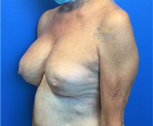 Breast Implant Revision After Photo by Ankit Desai, MD; Jacksonville, FL - Case 40568