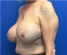 Breast Implant Revision Before Photo by Ankit Desai, MD; Jacksonville, FL - Case 40568