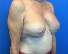 Breast Implant Revision After Photo by Ankit Desai, MD; Jacksonville, FL - Case 40568