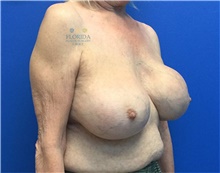 Breast Implant Revision Before Photo by Ankit Desai, MD; Jacksonville, FL - Case 40568