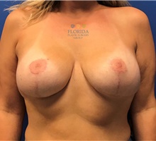 Breast Implant Revision After Photo by Ankit Desai, MD; Jacksonville, FL - Case 40680