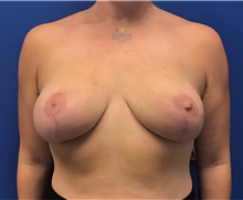 Breast Lift After Photo by Ankit Desai, MD; Jacksonville, FL - Case 41563