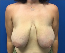 Breast Lift Before Photo by Ankit Desai, MD; Jacksonville, FL - Case 41563