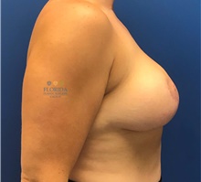 Breast Lift After Photo by Ankit Desai, MD; Jacksonville, FL - Case 41563