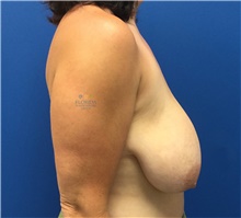 Breast Lift Before Photo by Ankit Desai, MD; Jacksonville, FL - Case 41563