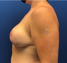 Breast Lift After Photo by Ankit Desai, MD; Jacksonville, FL - Case 41563