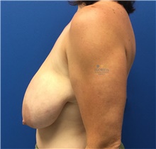 Breast Lift Before Photo by Ankit Desai, MD; Jacksonville, FL - Case 41563