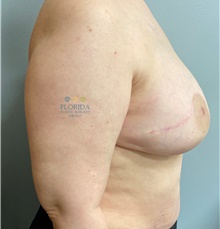Breast Reconstruction After Photo by Ankit Desai, MD; Jacksonville, FL - Case 41698