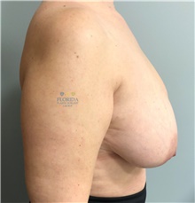 Breast Reconstruction Before Photo by Ankit Desai, MD; Jacksonville, FL - Case 41698