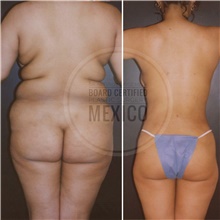 Body Contouring After Photo by Arturo Munoz Meza, MD; Tijuana, B.C. - Case 40878