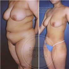 Body Contouring Before Photo by Arturo Munoz Meza, MD; Tijuana, B.C. - Case 40878