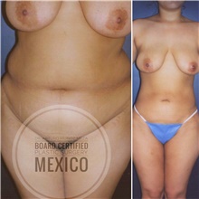 Body Contouring Before Photo by Arturo Munoz Meza, MD; Tijuana, B.C. - Case 40878