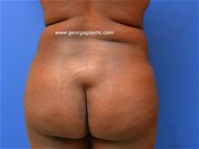 Buttock Lift with Augmentation Before Photo by Stanley Okoro, MD; Marietta, GA - Case 28262