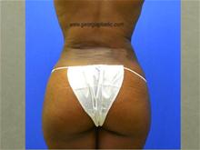 Buttock Lift with Augmentation After Photo by Stanley Okoro, MD; Marietta, GA - Case 28263