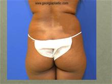 Buttock Lift with Augmentation Before Photo by Stanley Okoro, MD; Marietta, GA - Case 28263
