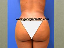 Buttock Lift with Augmentation After Photo by Stanley Okoro, MD; Marietta, GA - Case 28264