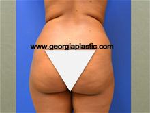 Buttock Lift with Augmentation Before Photo by Stanley Okoro, MD; Marietta, GA - Case 28264