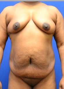 Tummy Tuck Before Photo by Stanley Okoro, MD; Marietta, GA - Case 44831