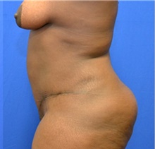 Tummy Tuck After Photo by Stanley Okoro, MD; Marietta, GA - Case 44833