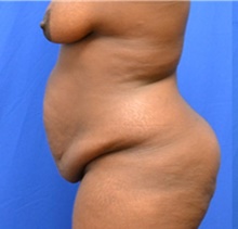 Tummy Tuck Before Photo by Stanley Okoro, MD; Marietta, GA - Case 44833