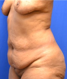 Tummy Tuck Before Photo by Stanley Okoro, MD; Marietta, GA - Case 44835