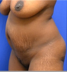 Tummy Tuck Before Photo by Stanley Okoro, MD; Marietta, GA - Case 44838