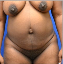 Tummy Tuck Before Photo by Stanley Okoro, MD; Marietta, GA - Case 44839