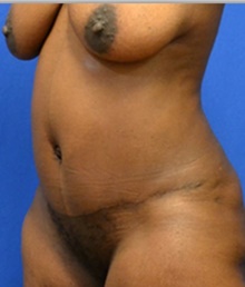 Tummy Tuck After Photo by Stanley Okoro, MD; Marietta, GA - Case 44839