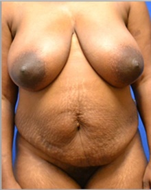 Tummy Tuck Before Photo by Stanley Okoro, MD; Marietta, GA - Case 44840