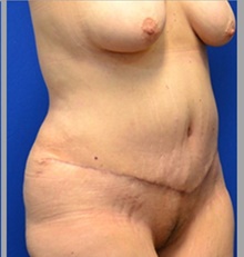 Tummy Tuck After Photo by Stanley Okoro, MD; Marietta, GA - Case 44841