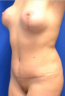 Tummy Tuck After Photo by Stanley Okoro, MD; Marietta, GA - Case 44843