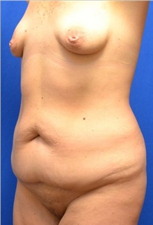 Tummy Tuck Before Photo by Stanley Okoro, MD; Marietta, GA - Case 44843