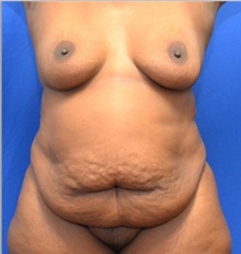 Tummy Tuck Before Photo by Stanley Okoro, MD; Marietta, GA - Case 44845