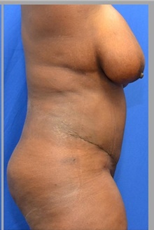 Tummy Tuck After Photo by Stanley Okoro, MD; Marietta, GA - Case 44846