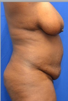 Tummy Tuck Before Photo by Stanley Okoro, MD; Marietta, GA - Case 44846